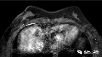【PPT】乳腺疾病病例读片-1