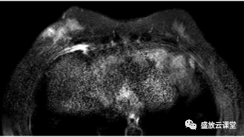 【PPT】乳腺疾病病例读片-3