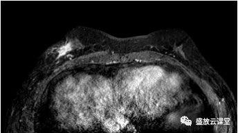 【PPT】乳腺疾病病例读片-2