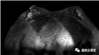 【PPT】乳腺疾病病例读片-4