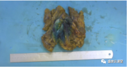 【PPT】乳腺疾病病例读片-7 【PPT】乳腺疾病病例读片-7