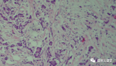 【PPT】乳腺疾病病例读片-8 【PPT】乳腺疾病病例读片-8