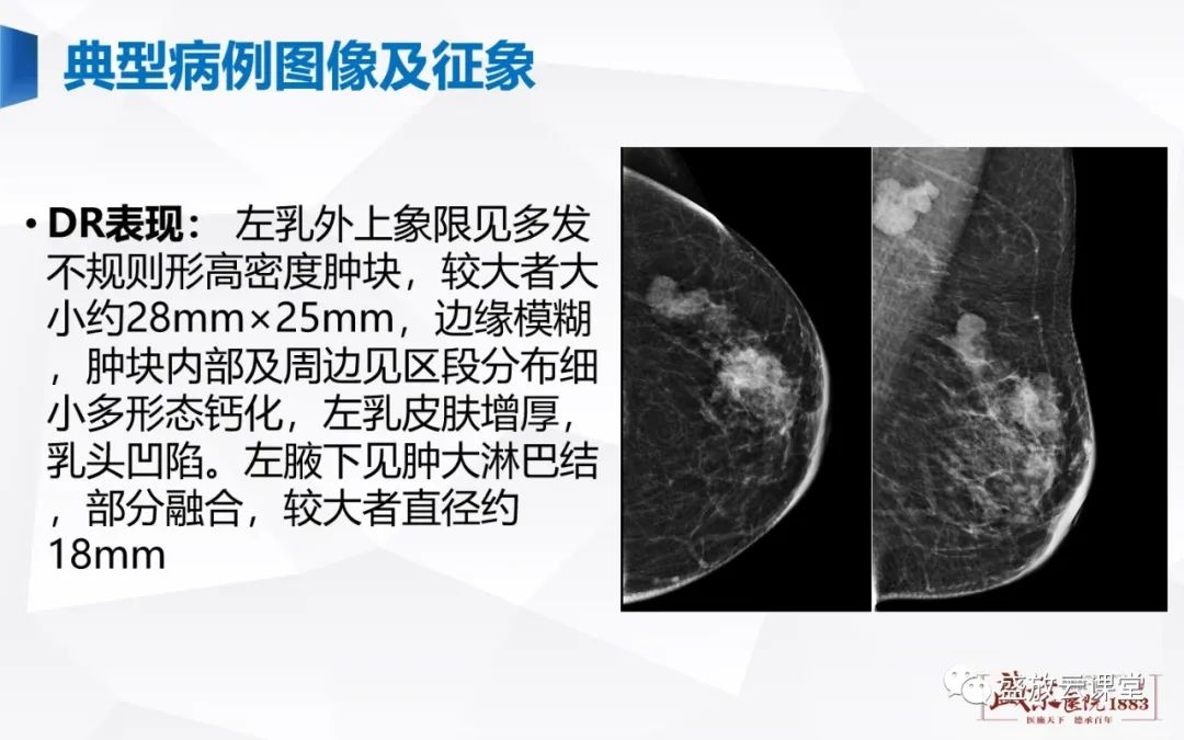 【PPT】乳腺疾病病例读片-4 【PPT】乳腺疾病病例读片-4