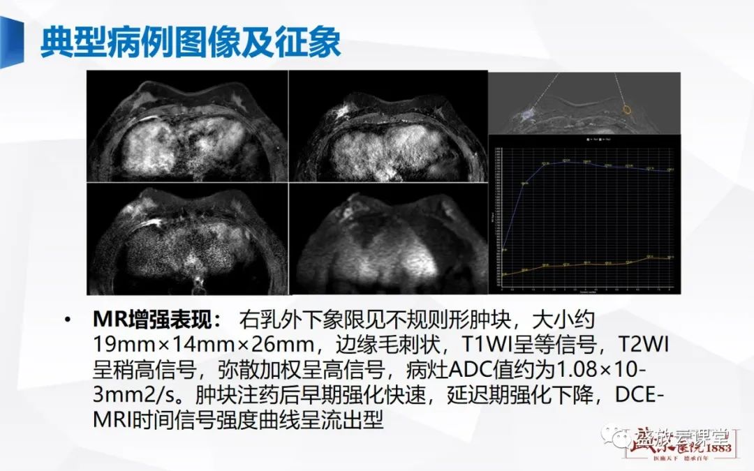 【PPT】乳腺疾病病例读片-8 【PPT】乳腺疾病病例读片-8