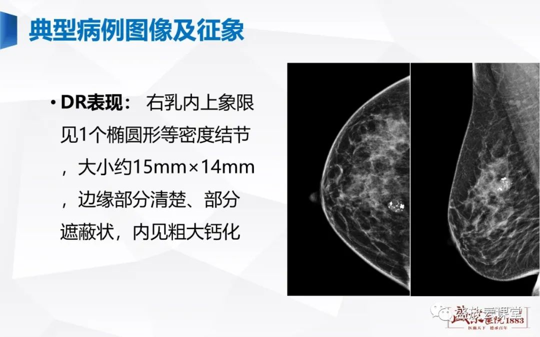 【PPT】乳腺疾病病例读片-14 【PPT】乳腺疾病病例读片-14