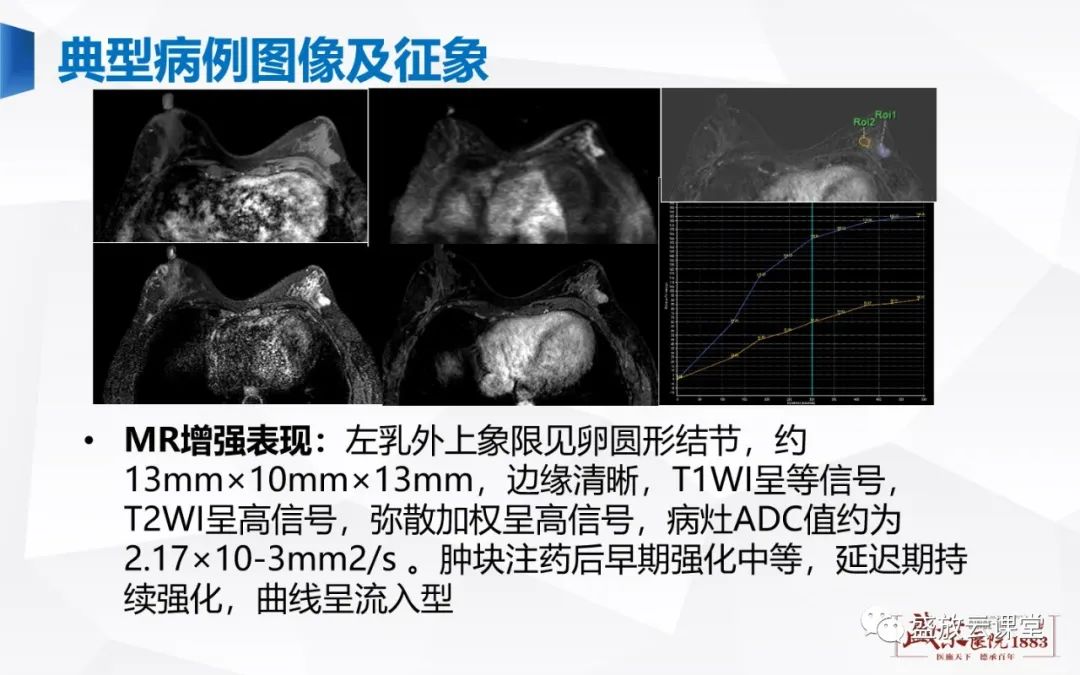 【PPT】乳腺疾病病例读片-18 【PPT】乳腺疾病病例读片-18