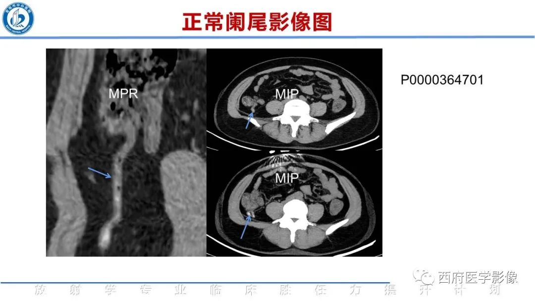 【PPT】阑尾解剖及阑尾炎影像诊断-12