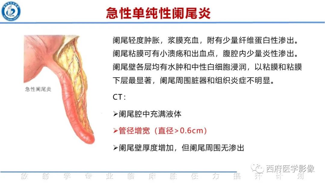 【PPT】阑尾解剖及阑尾炎影像诊断-13
