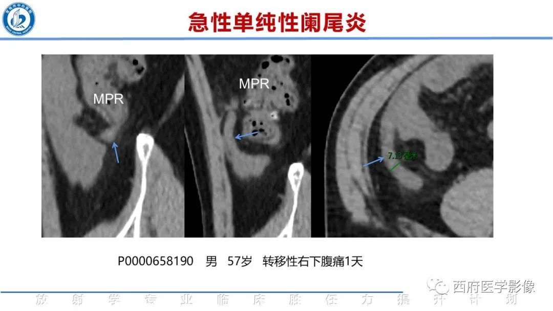 【PPT】阑尾解剖及阑尾炎影像诊断-14