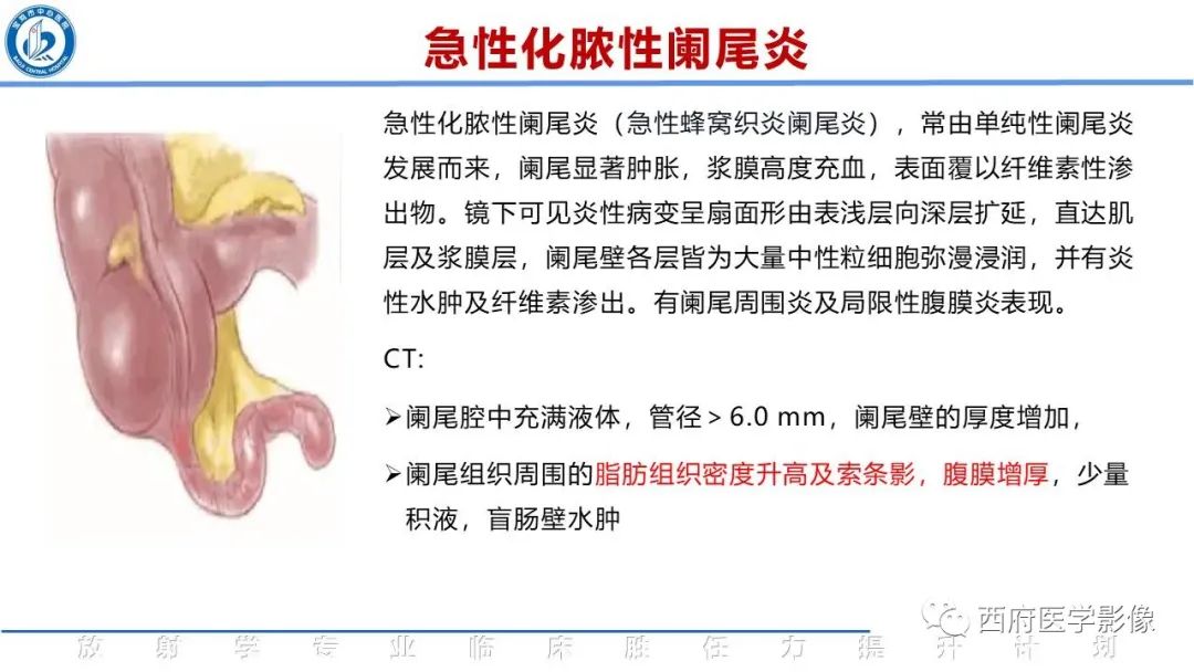 【PPT】阑尾解剖及阑尾炎影像诊断-15