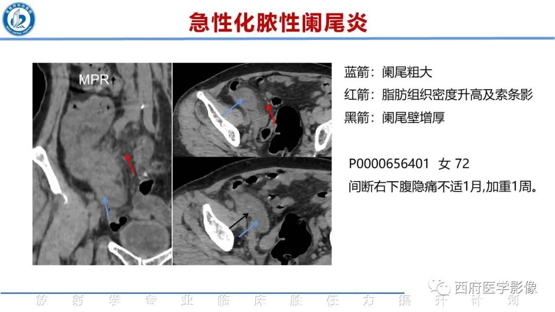 【PPT】阑尾解剖及阑尾炎影像诊断-16