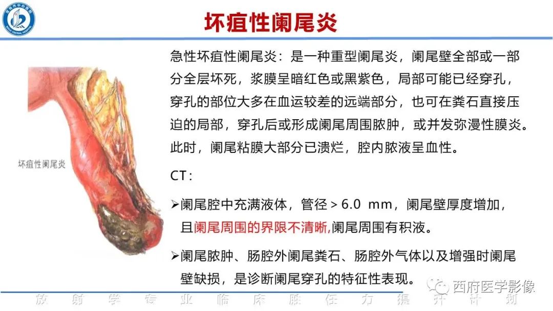 【PPT】阑尾解剖及阑尾炎影像诊断-17