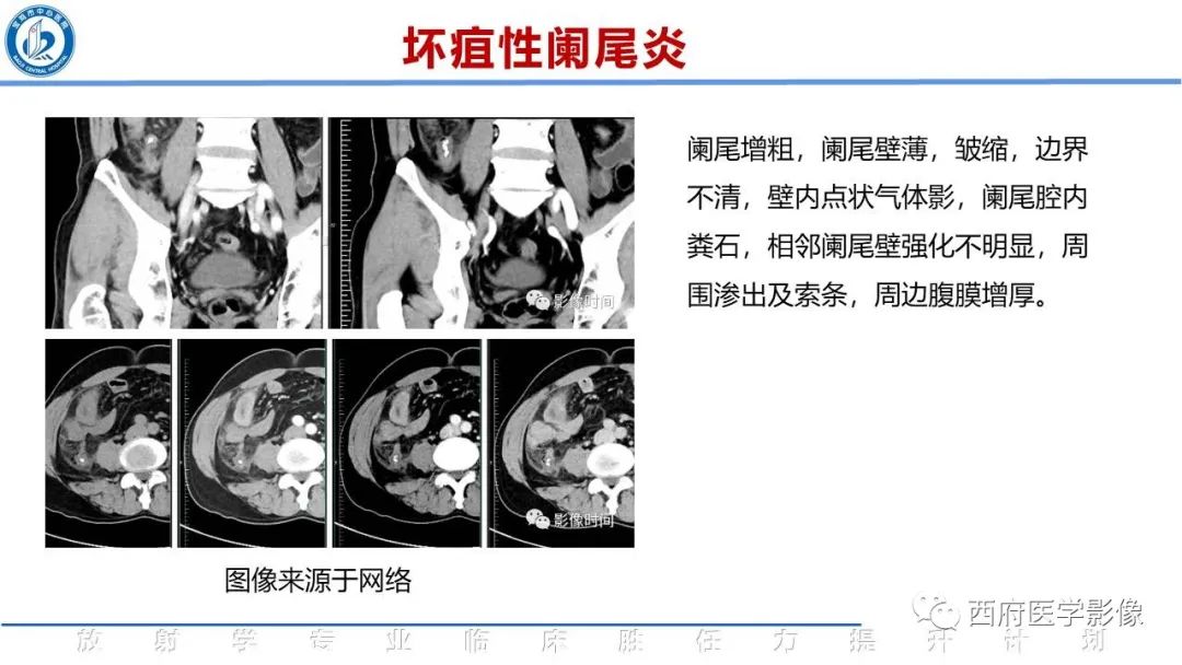 【PPT】阑尾解剖及阑尾炎影像诊断-18
