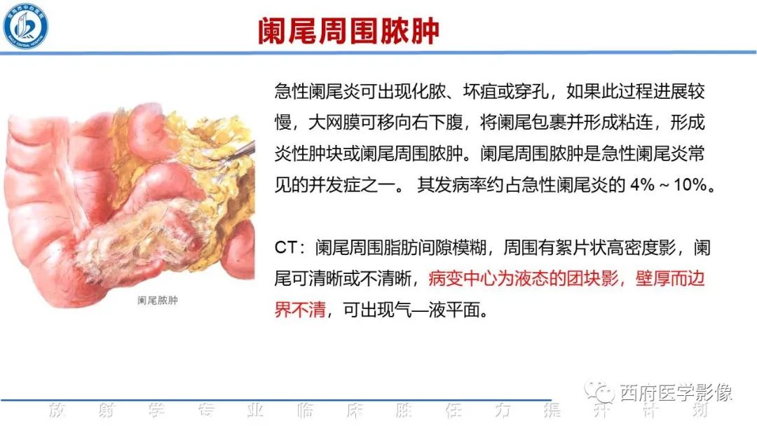 【PPT】阑尾解剖及阑尾炎影像诊断-19