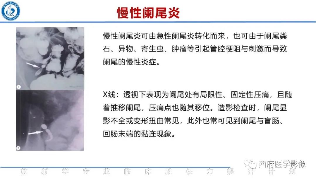 【PPT】阑尾解剖及阑尾炎影像诊断-23