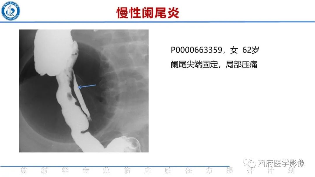 【PPT】阑尾解剖及阑尾炎影像诊断-24