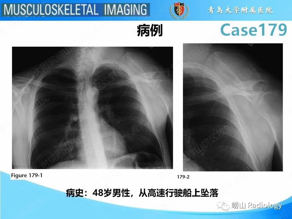 【PPT】肩胛胸壁分离-2