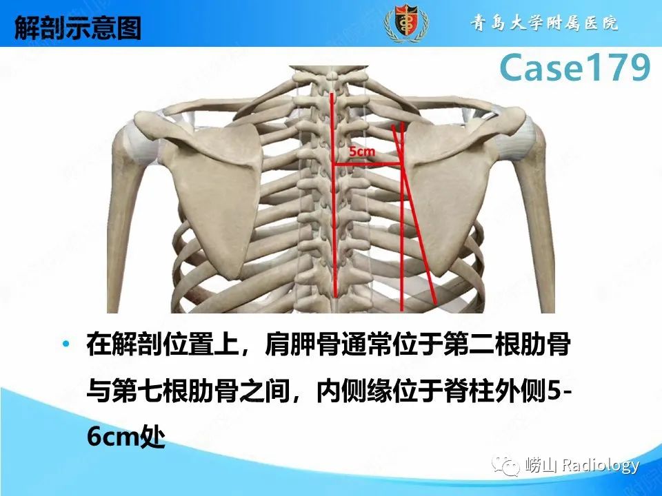 【PPT】肩胛胸壁分离-12