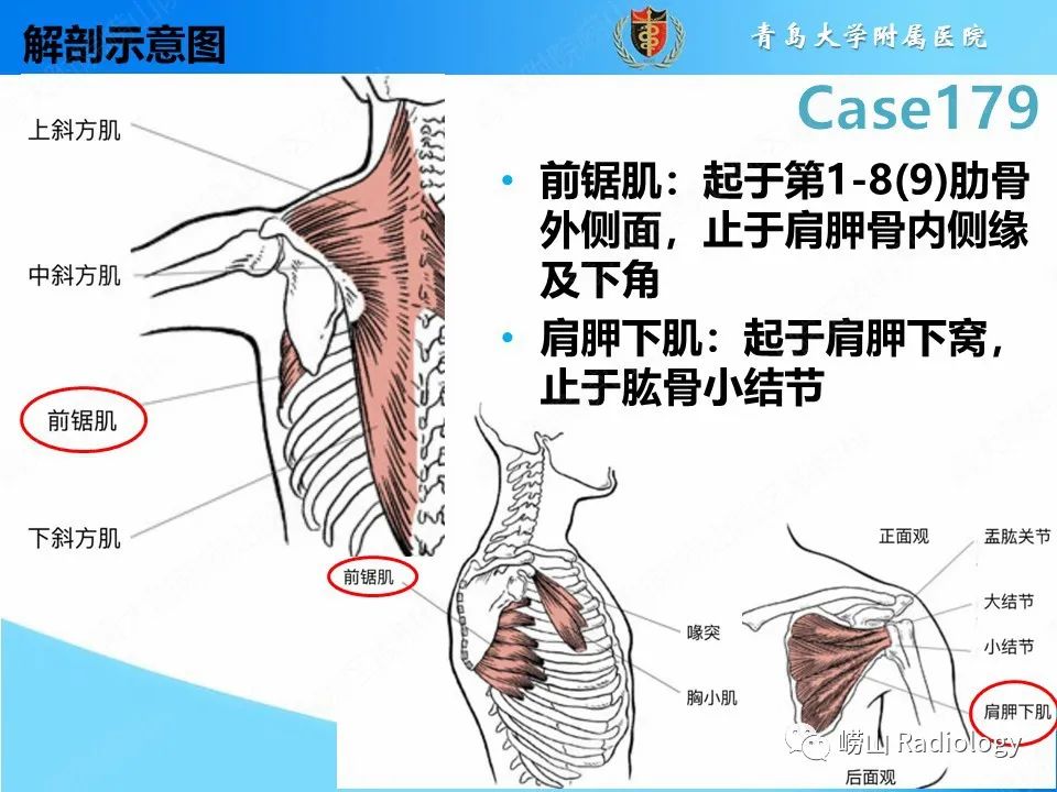 【PPT】肩胛胸壁分离-14