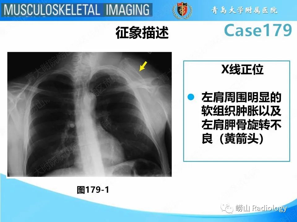 【PPT】肩胛胸壁分离-20