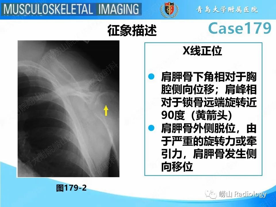 【PPT】肩胛胸壁分离-21