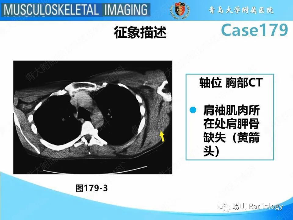 【PPT】肩胛胸壁分离-22