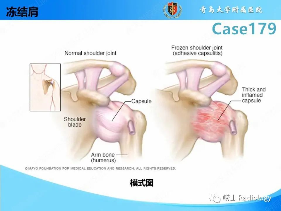 【PPT】肩胛胸壁分离-27