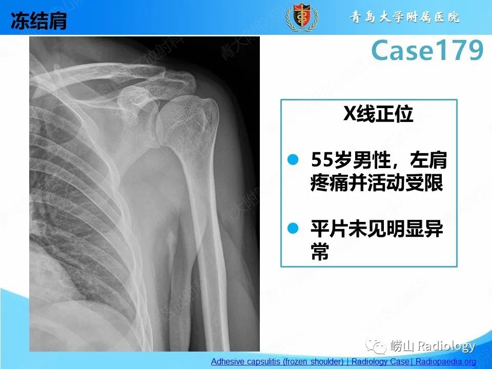 【PPT】肩胛胸壁分离-28