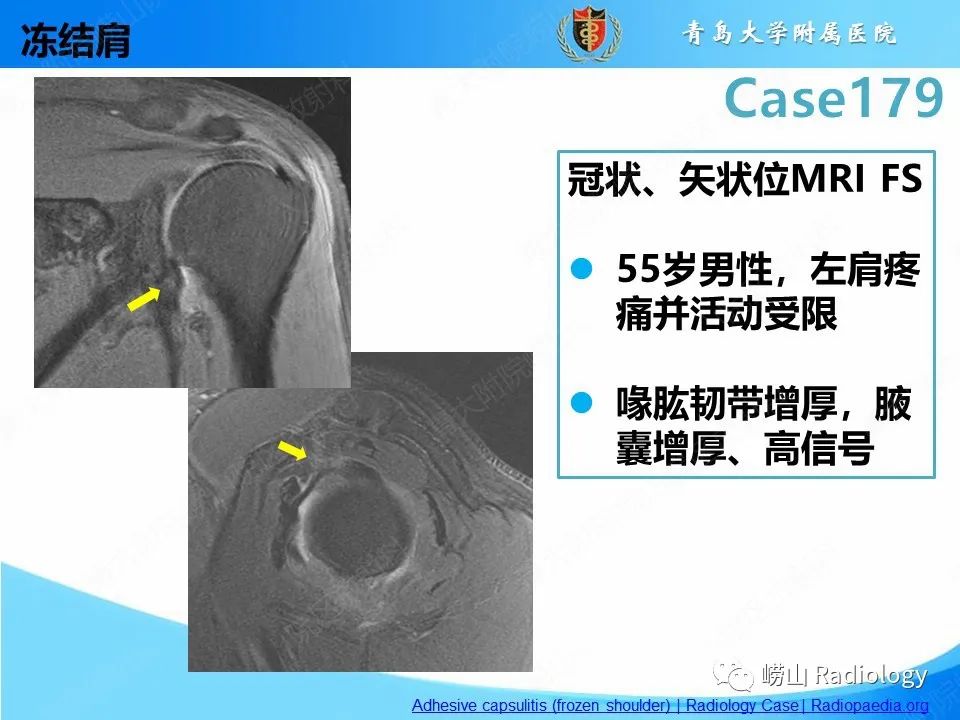 【PPT】肩胛胸壁分离-29
