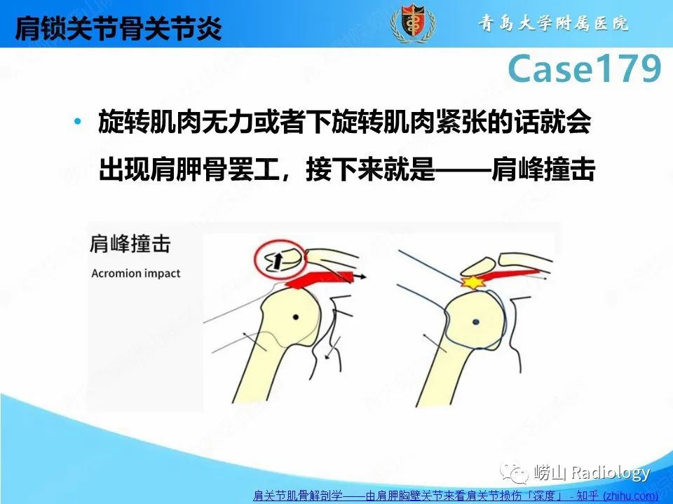 【PPT】肩胛胸壁分离-30