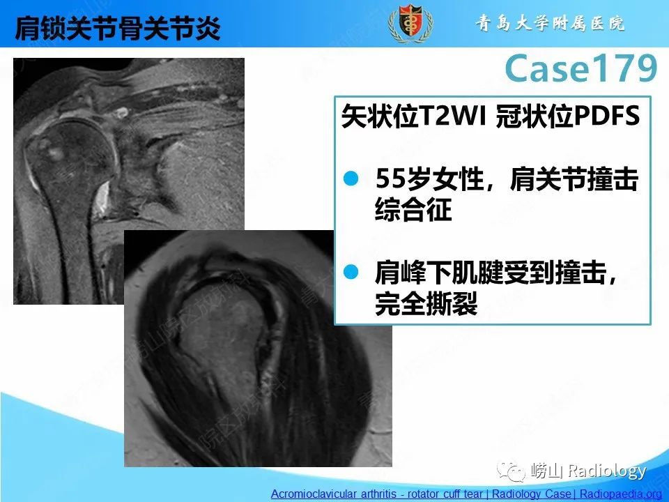 【PPT】肩胛胸壁分离-31