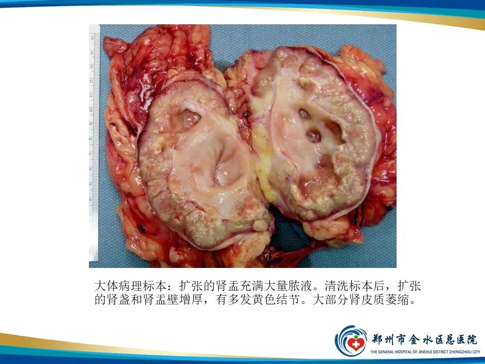 【PPT】黄色肉芽肿性肾盂肾炎影像表现-9