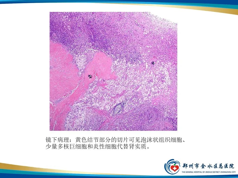 【PPT】黄色肉芽肿性肾盂肾炎影像表现-10