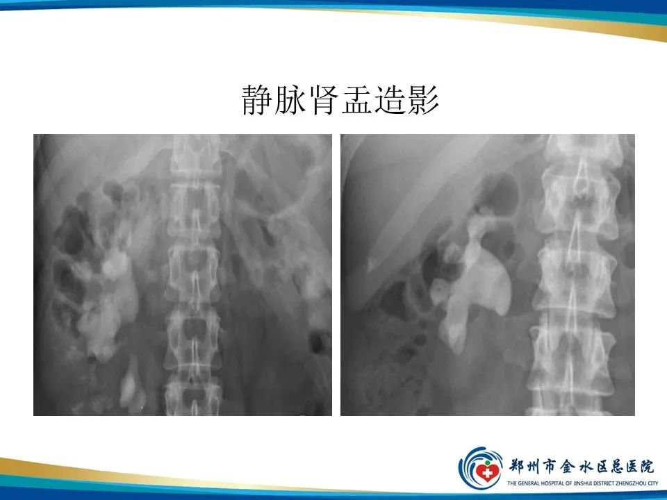 【PPT】黄色肉芽肿性肾盂肾炎影像表现-14
