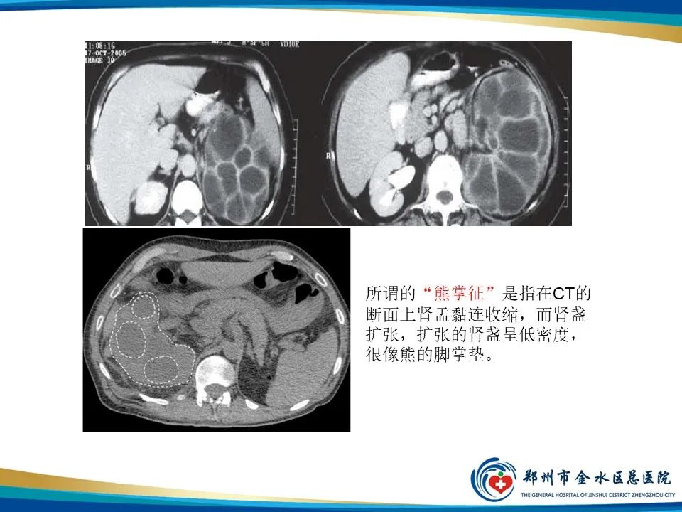 【PPT】黄色肉芽肿性肾盂肾炎影像表现-17