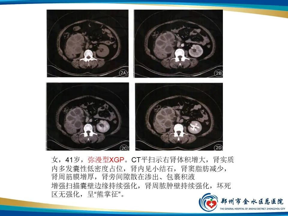 【PPT】黄色肉芽肿性肾盂肾炎影像表现-18