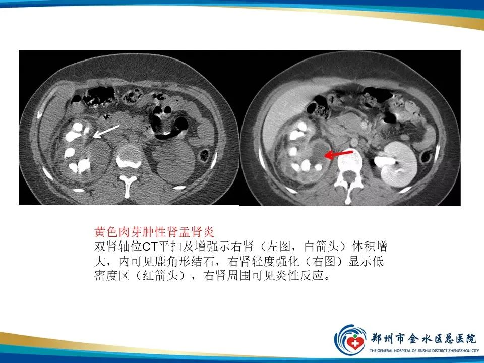【PPT】黄色肉芽肿性肾盂肾炎影像表现-19
