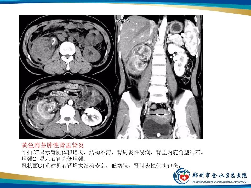 【PPT】黄色肉芽肿性肾盂肾炎影像表现-20
