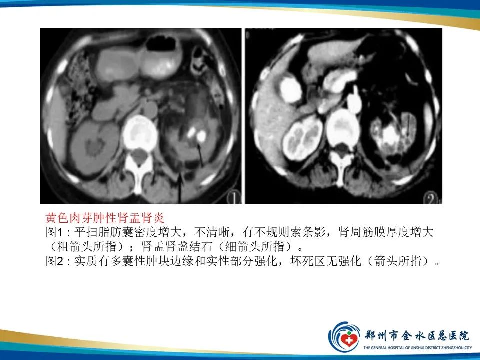 【PPT】黄色肉芽肿性肾盂肾炎影像表现-21