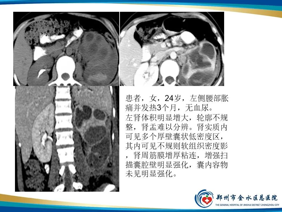 【PPT】黄色肉芽肿性肾盂肾炎影像表现-22