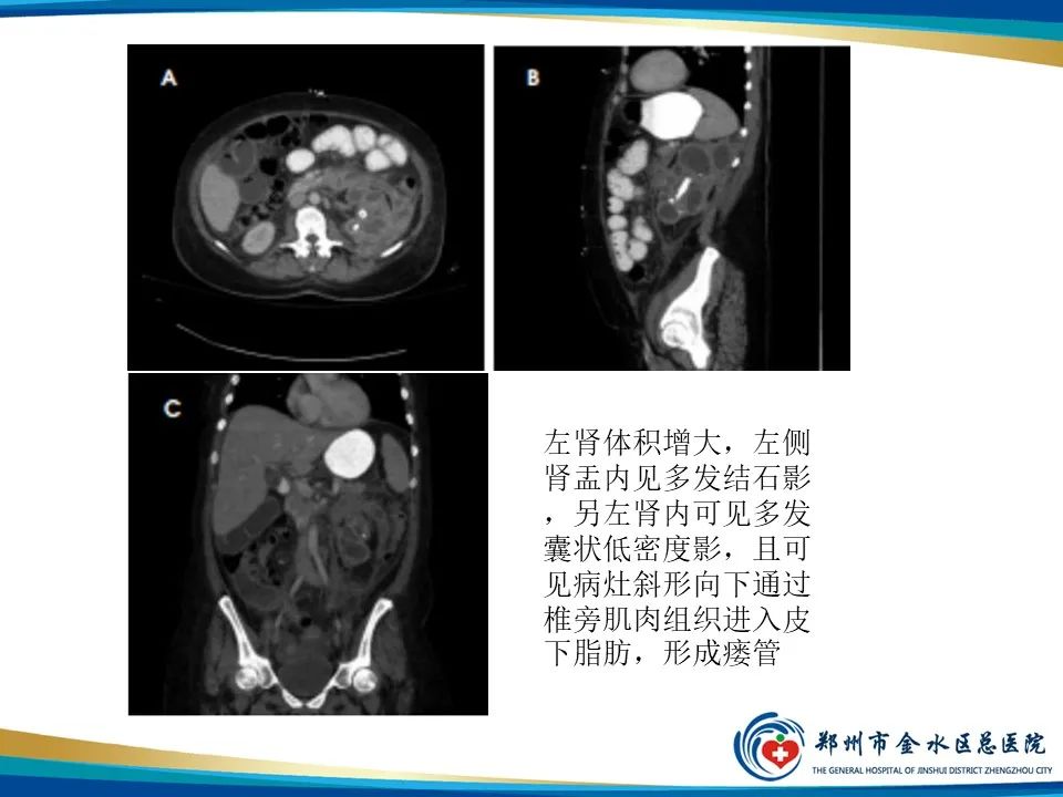 【PPT】黄色肉芽肿性肾盂肾炎影像表现-23