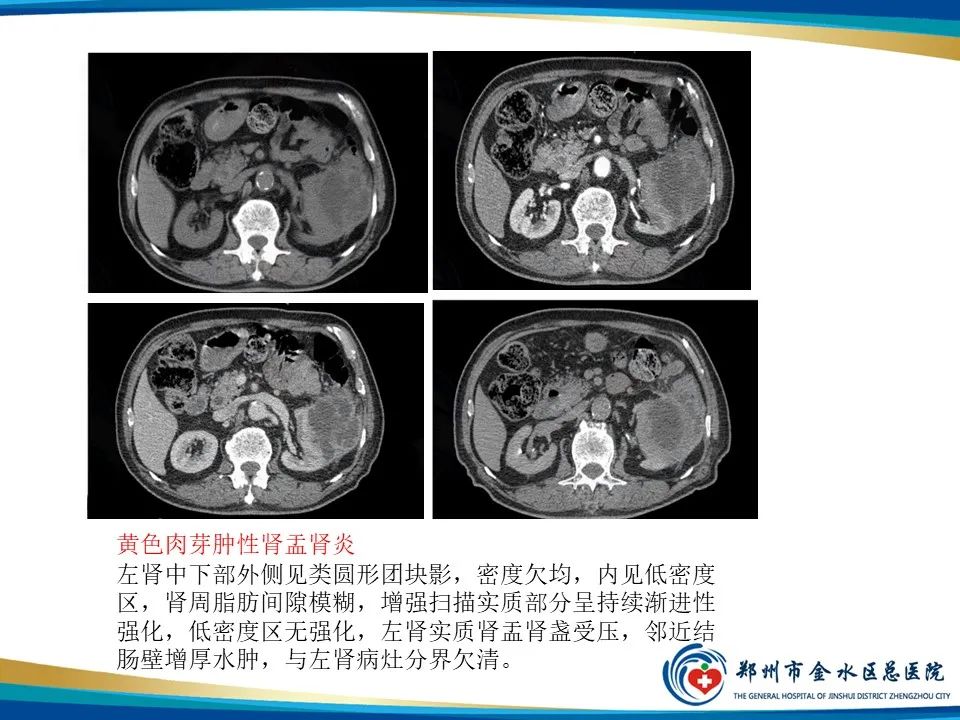 【PPT】黄色肉芽肿性肾盂肾炎影像表现-25