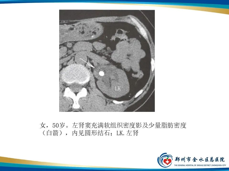 【PPT】黄色肉芽肿性肾盂肾炎影像表现-26