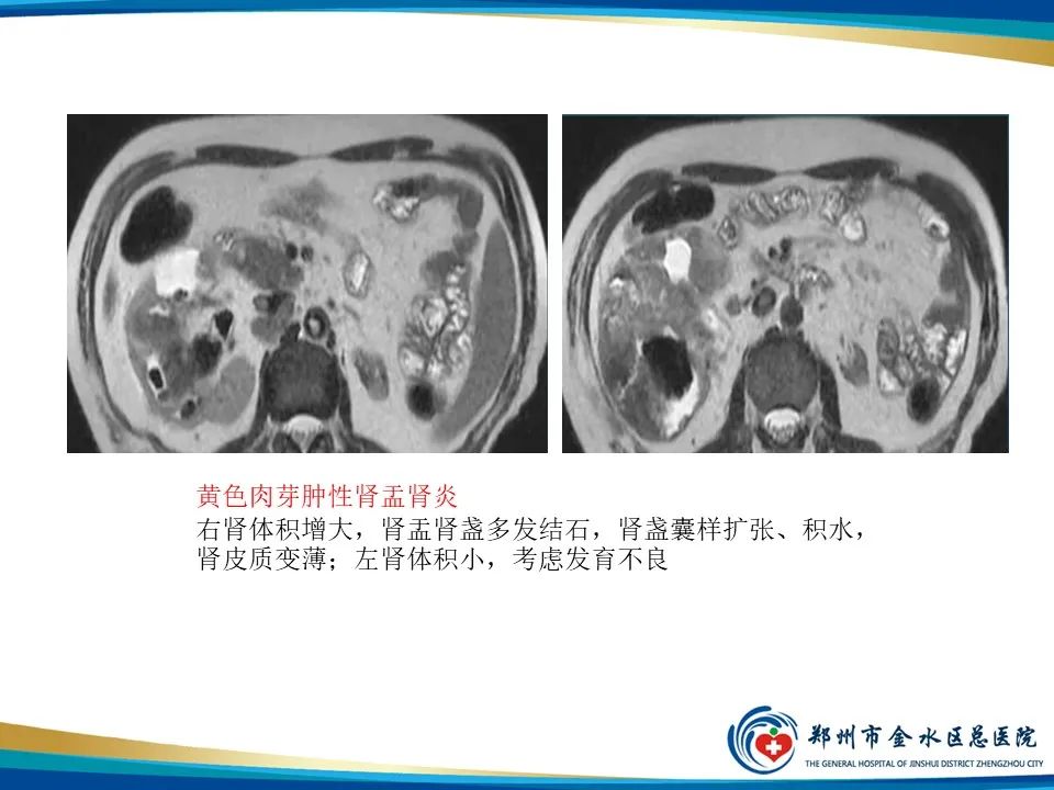 【PPT】黄色肉芽肿性肾盂肾炎影像表现-28