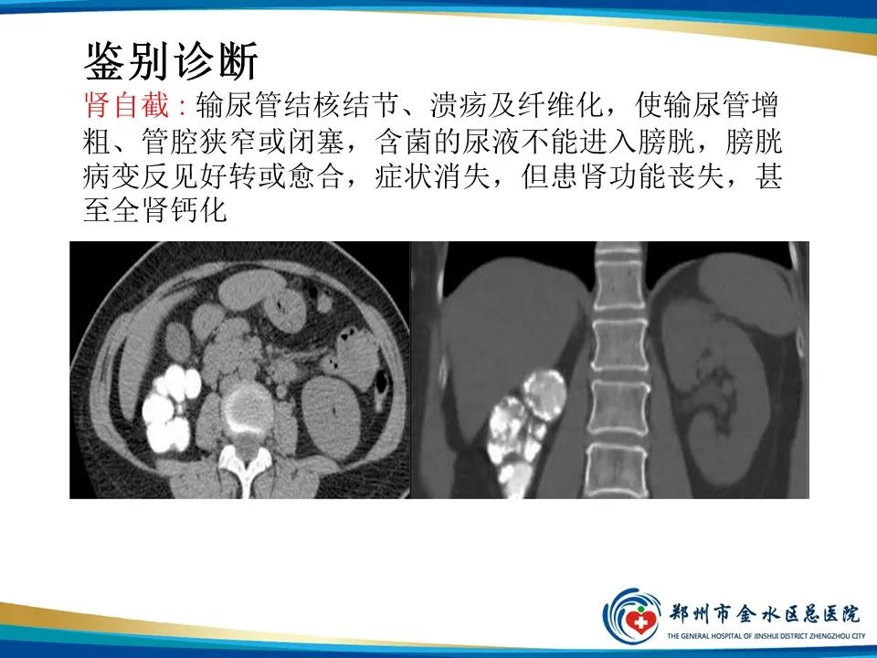 【PPT】黄色肉芽肿性肾盂肾炎影像表现-30