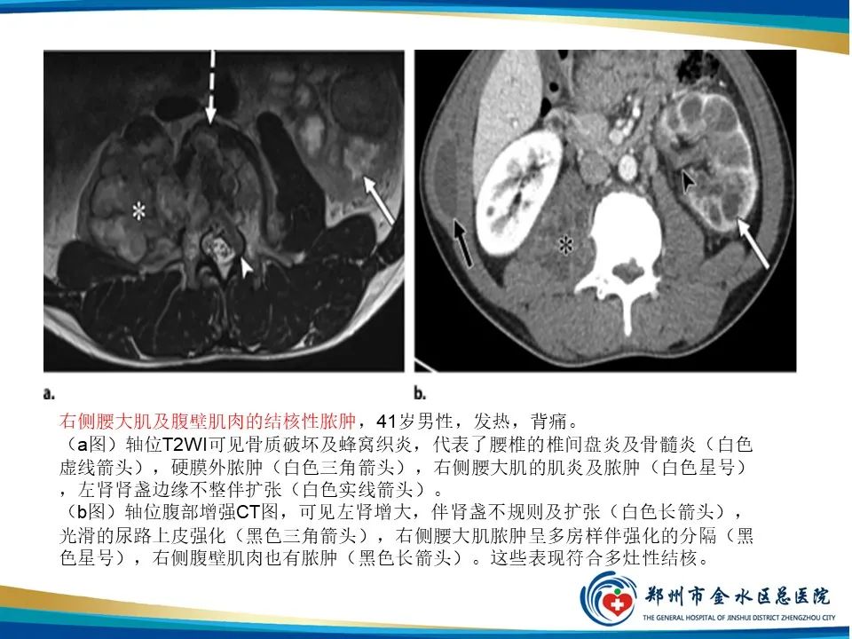 【PPT】黄色肉芽肿性肾盂肾炎影像表现-32