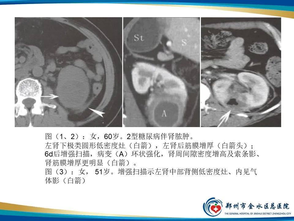 【PPT】黄色肉芽肿性肾盂肾炎影像表现-34