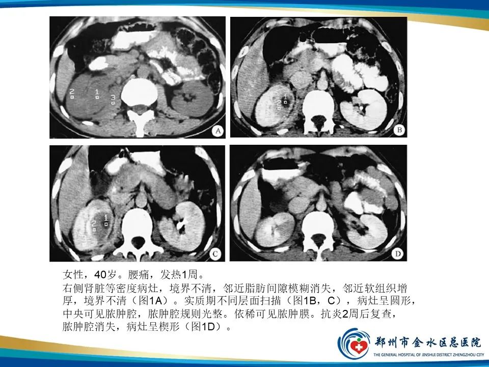 【PPT】黄色肉芽肿性肾盂肾炎影像表现-35