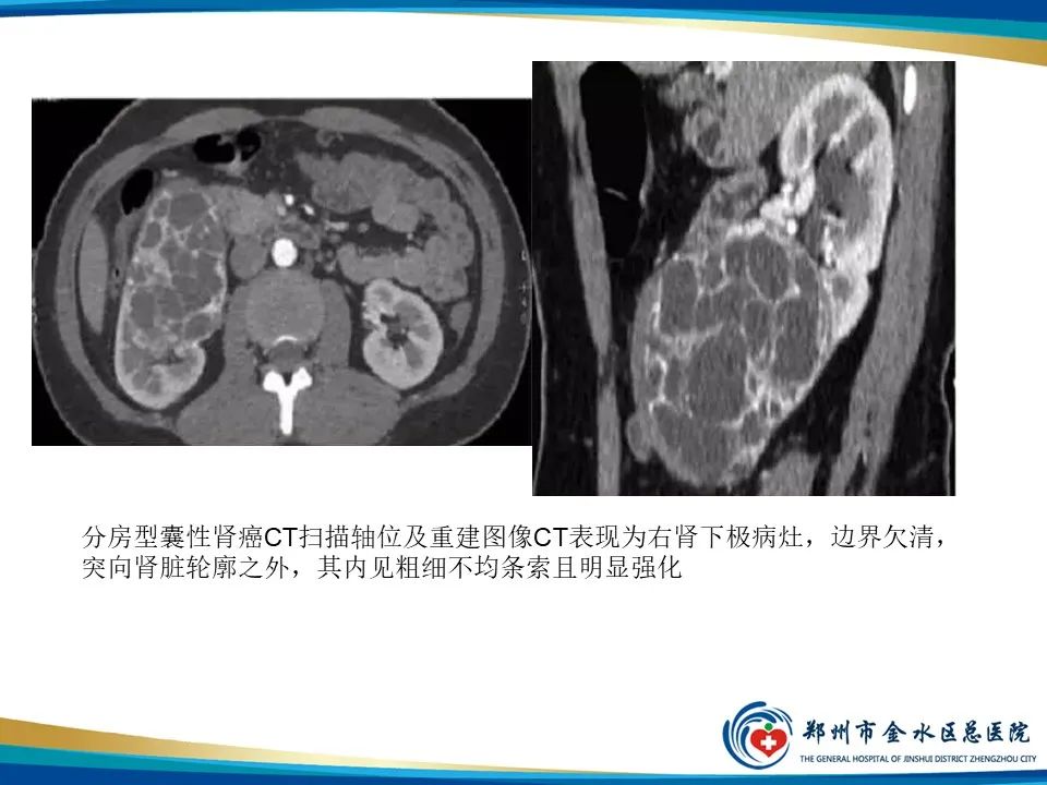 【PPT】黄色肉芽肿性肾盂肾炎影像表现-38