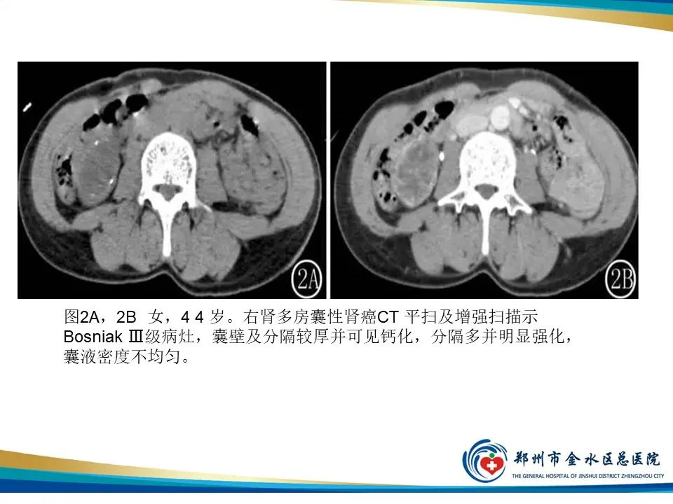 【PPT】黄色肉芽肿性肾盂肾炎影像表现-39
